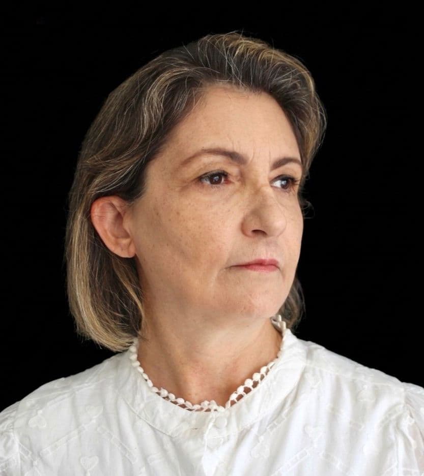 Preenchimento Mandíbula — antes e depois