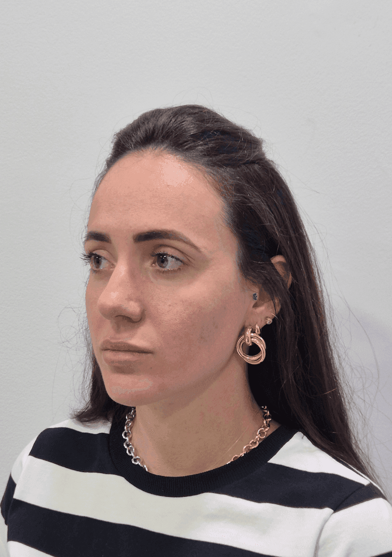 Botox — antes e depois
