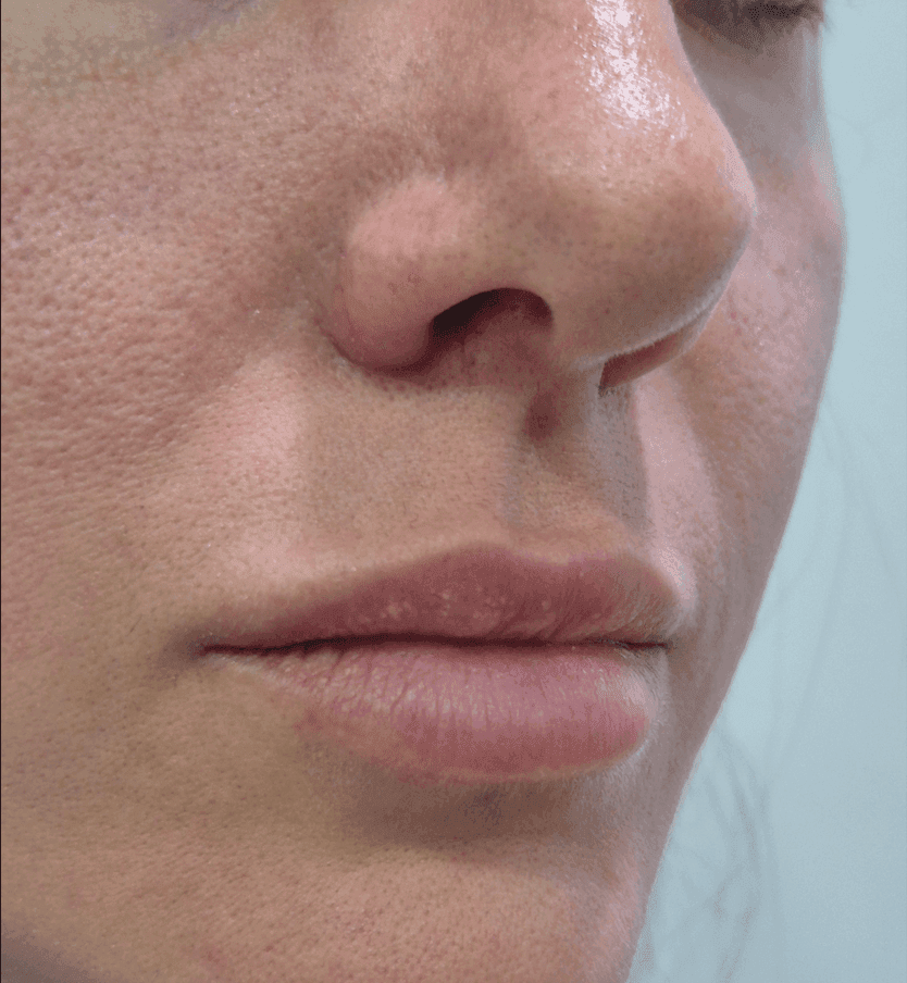 Preenchimento Labial — antes e depois