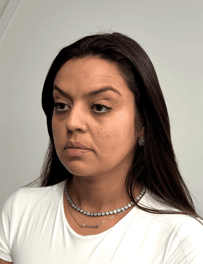 Preenchimento de Olheiras — antes e depois