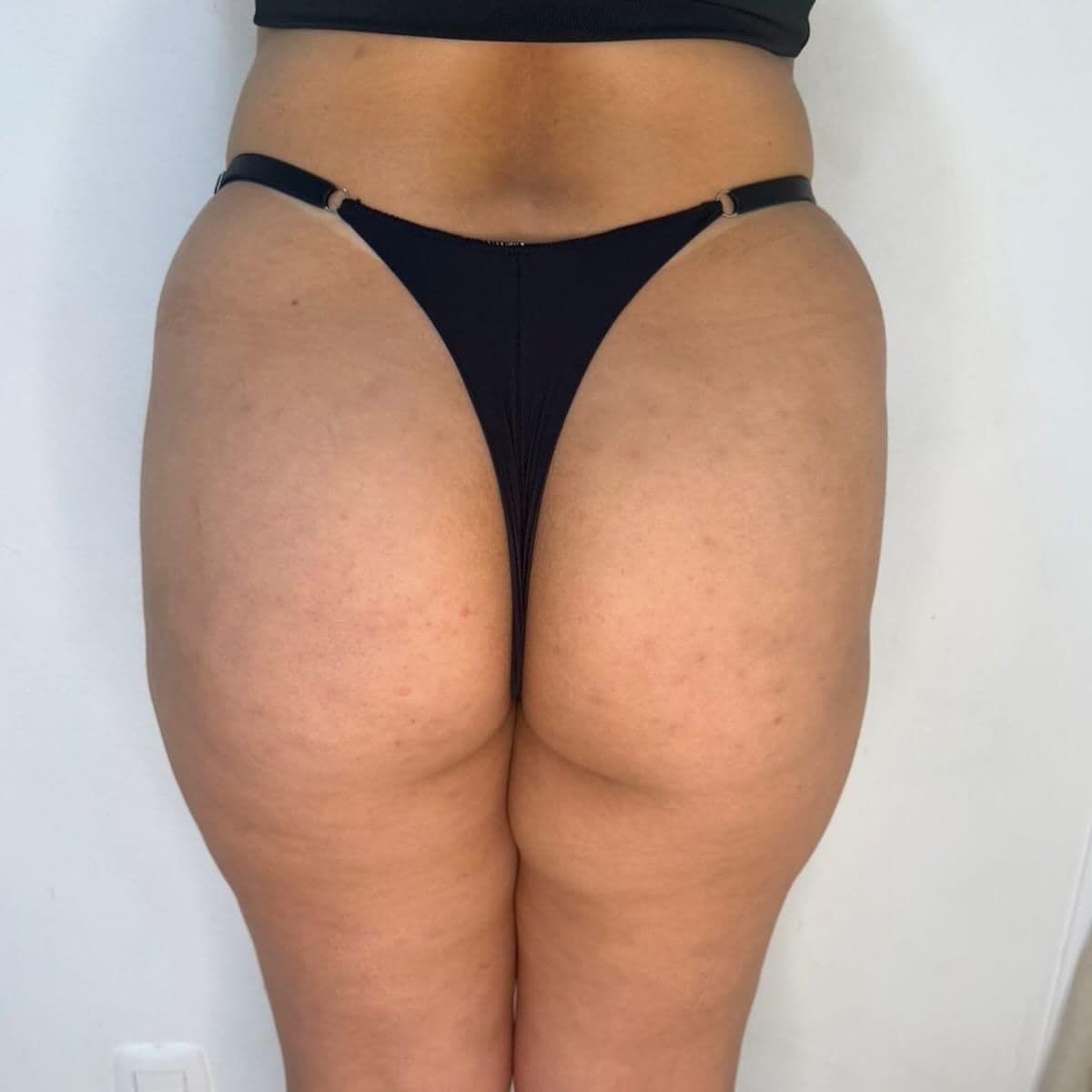 Bumbum Up — antes e depois
